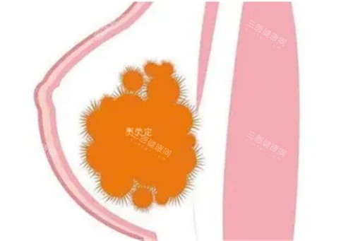 胸部奥美定 胸部奥美定