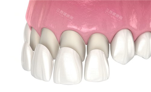 前牙四颗牙齿贴面