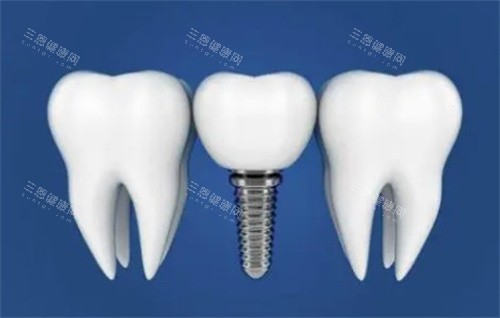 种植体与真实牙齿对比漫画图