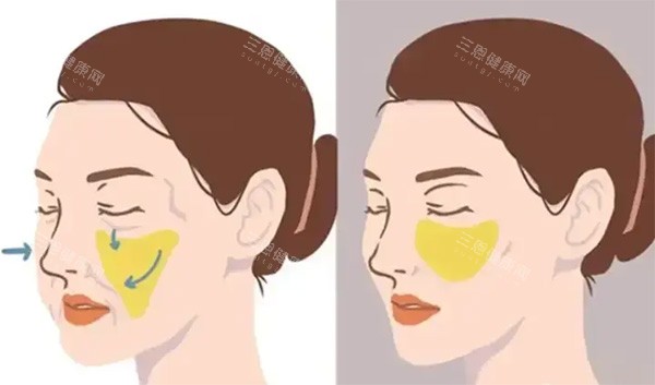 馒化脸脂肪移位照片 馒化脸脂肪移位照片