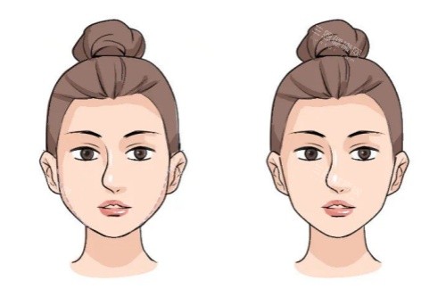 面部馒化修复卡通对比图 面部馒化修复卡通对比图