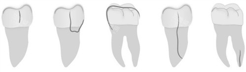 牙齿裂纹方向 牙齿裂纹方向