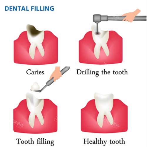 修复龋坏的牙齿 修复龋坏的牙齿