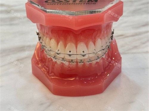 牙齿矫正陶瓷托槽牙套模型图 牙齿矫正陶瓷托槽牙套模型图