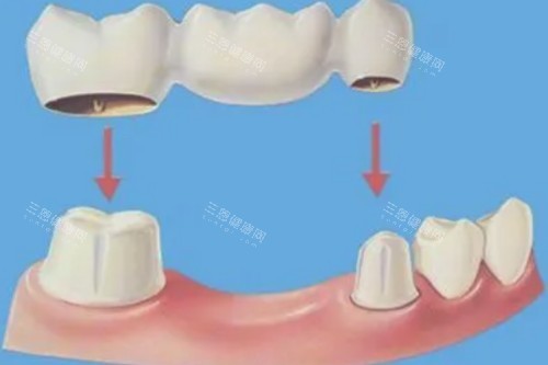 镶牙模型图 镶牙模型图