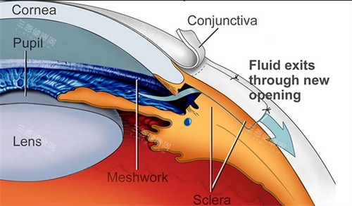 青光眼出现问题的部位 青光眼出现问题的部位