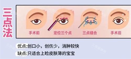 双眼皮手术三点法动画演示图 双眼皮手术三点法动画演示图
