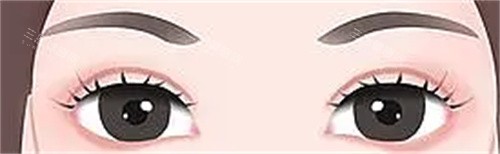 双眼皮术后示意图 双眼皮术后示意图
