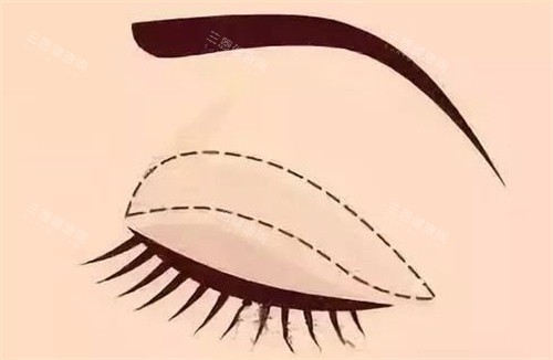 全切双眼皮 全切双眼皮