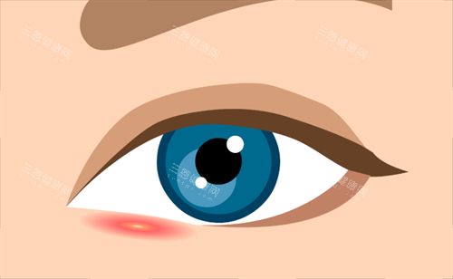 双眼皮疤痕 双眼皮疤痕