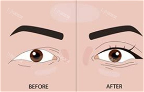 双眼皮手术前后对比 双眼皮手术前后对比