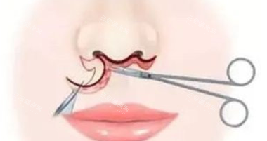 胡俊杰人中缩短价格与结果深度揭秘：人中窝3D加深技术真人实例及术后自然度长期跟踪！