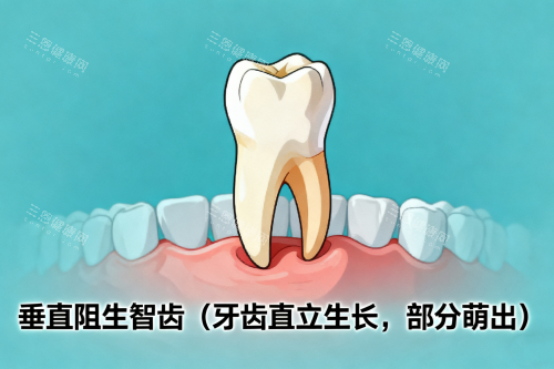垂直阻生智齿展示图