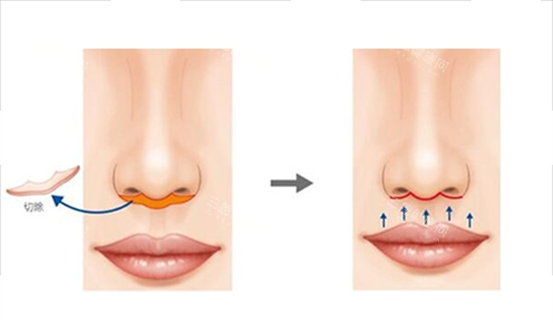 人中缩短手术切除部位 人中缩短手术切除部位