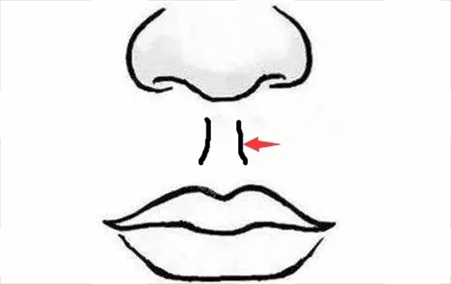 人中缩短术部位展示 人中缩短术部位展示