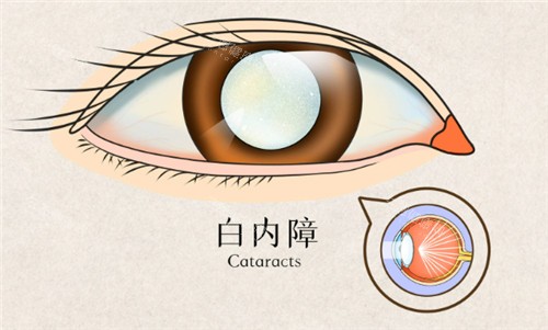 明水眼科医院白内障费用是多少？明水眼科白内障手术免费吗？
