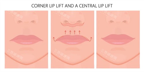 人中缩短手术动画图示 人中缩短手术动画图示