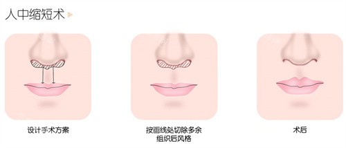 人中缩短术 人中缩短术