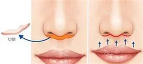 人中缩短手术 人中缩短手术
