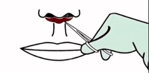 人中缩短手术动画图片 人中缩短手术动画图片