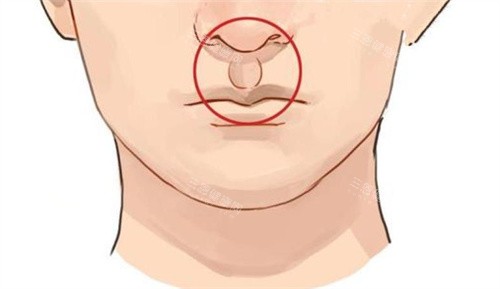 人中加深手术后 人中加深手术后