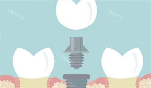 组成种植牙的三部分动画展示 组成种植牙的三部分动画展示