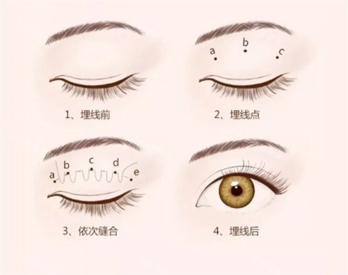 双眼皮埋线过程图 双眼皮埋线过程图