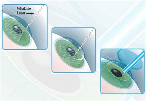 济南明水眼科哪个医生好？王东林/雷玉琳/葛金玲医生找的人比较多！