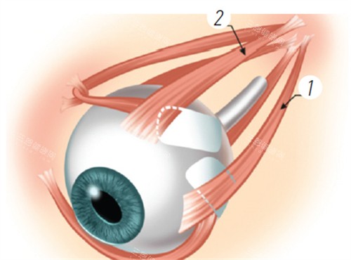 后巩膜加固术演示 后巩膜加固术演示