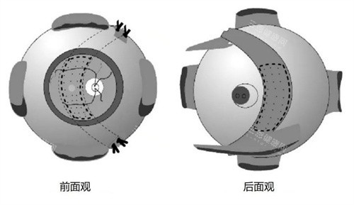 后巩膜加固 后巩膜加固