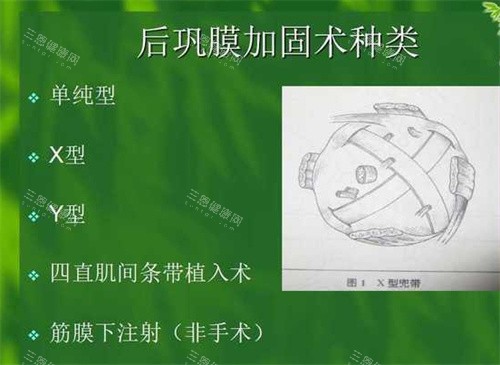 后巩膜加固术种类 后巩膜加固术种类