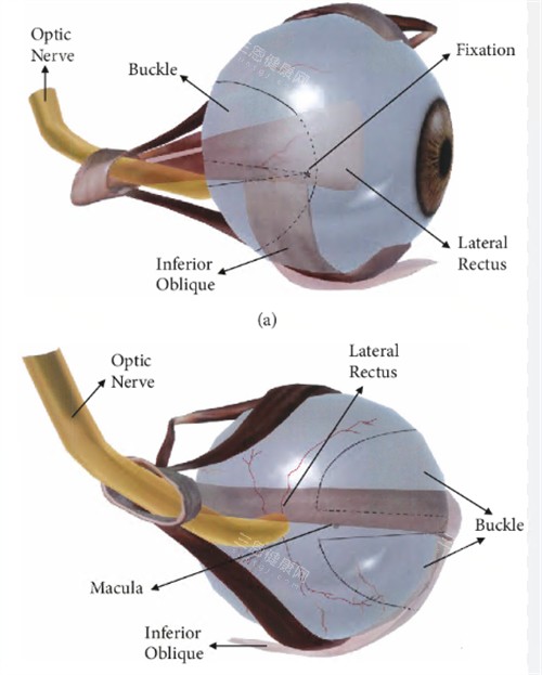 后巩膜加固术动画演示 后巩膜加固术动画演示