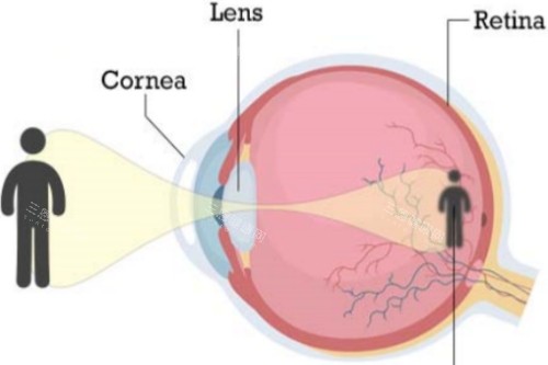 近视视物示意图 近视视物示意图