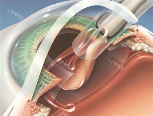 白内障手术细节图 白内障手术细节图