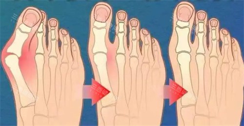 苏敬达医生大脚骨手术价格表1.28万元起揭秘,这份超全价目清单值得收藏!