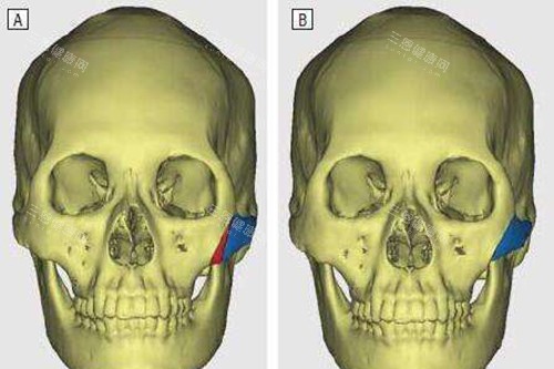 颧骨内推示意图 颧骨内推示意图
