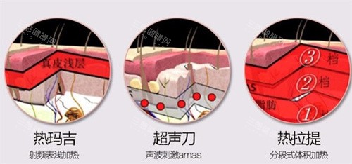 热玛吉、超声、热拉提 热玛吉、超声、热拉提