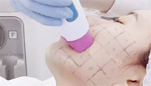 面部热玛吉治疗 面部热玛吉治疗