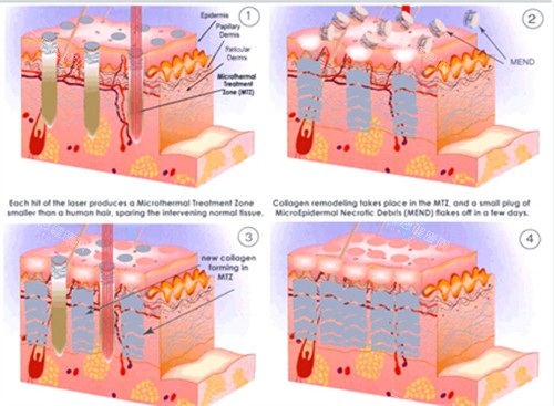 广药三院皮肤疤痕科怎么样？双波长皮秒+PRP疗法，色素疤返黑率低于5%，性价比比其他医院高