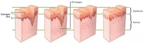 凹陷疤痕填充前后对比 凹陷疤痕填充前后对比