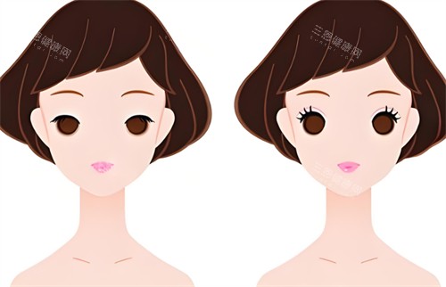 双眼皮前后对比图 双眼皮前后对比图