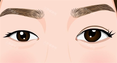 双眼皮手术术前术后对比卡通 双眼皮手术术前术后对比卡通