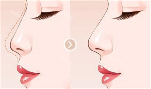 隆鼻手术对比图 隆鼻手术对比图