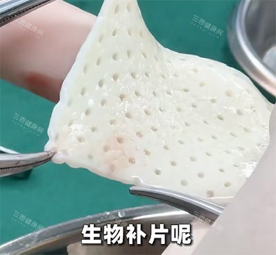 李世荣男性增粗延长预约攻略!重庆星荣面诊通道及生物补片技术解析