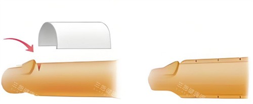 男性增粗手术示意图 男性增粗手术示意图