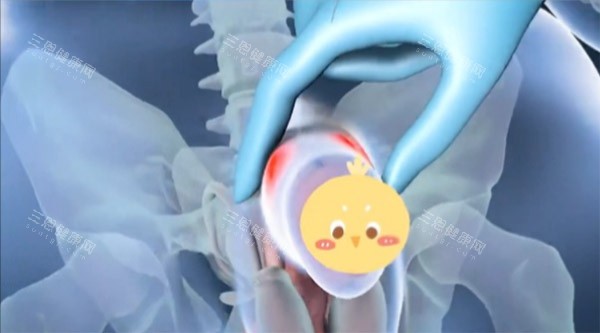 增大增粗手术照片 增大增粗手术照片