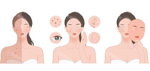 光子嫩肤治疗前后对比图