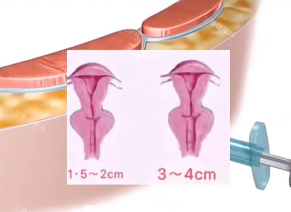 广州紧缩针价格大公开！天河/荔湾/白云优质医院推荐，预约方式一键get！