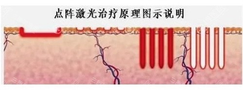 点阵激光祛疤 点阵激光祛疤