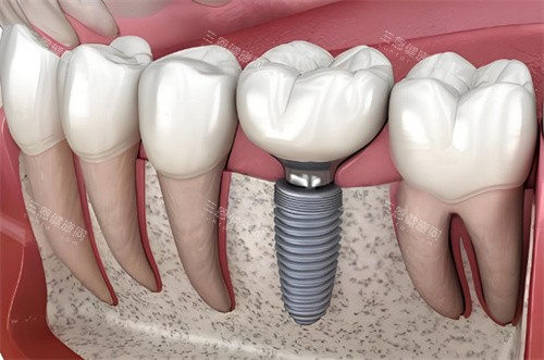 衡阳衡山2025牙科收费价格表被曝光！种植牙2500元起+矫正7200元起+根管治疗500元起+瓷贴面2500元